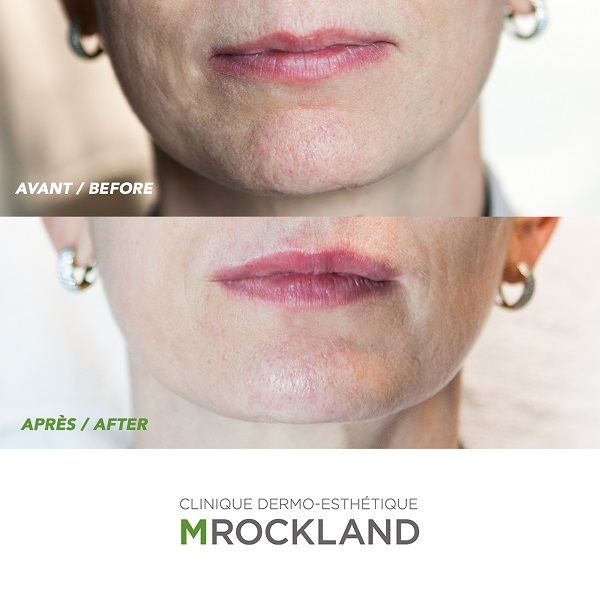 seduction-botox-cosmetique
