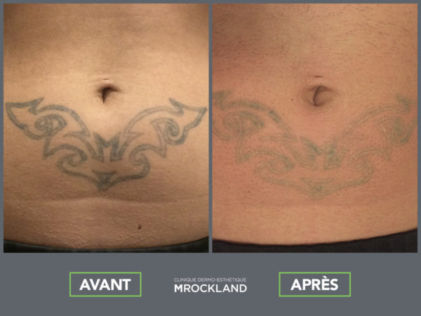 Détatouage